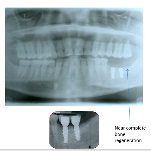 Bone Regeneration and Implants After