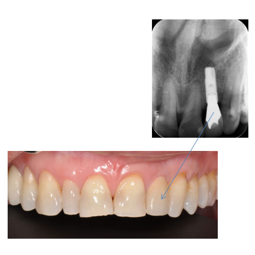 Extraction and Implant After