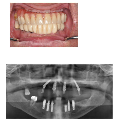 Upper and Lower Implants After