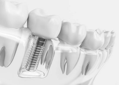 All-On-4 Dental Implants Cape Coral, FL - Modern Dental Cape Coral
