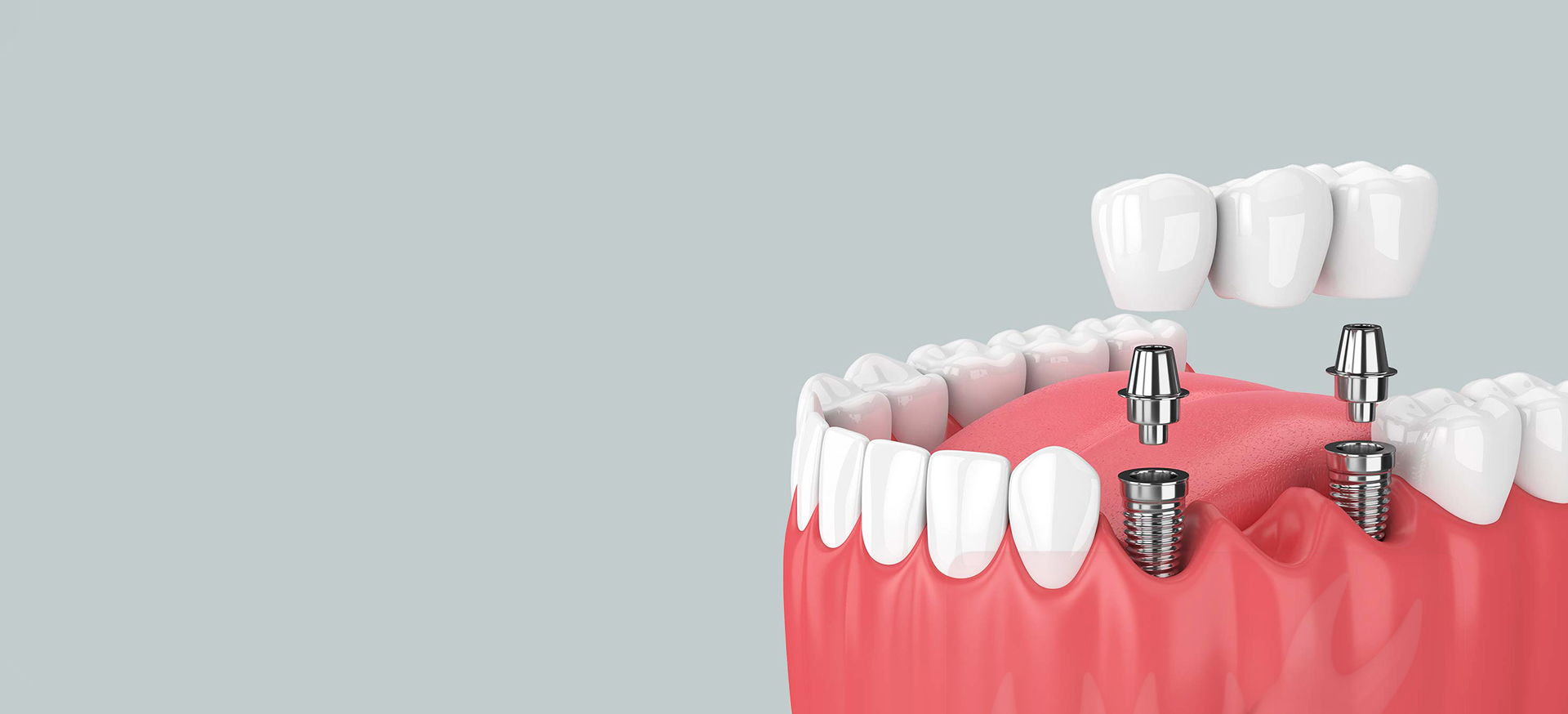 Don’t Let Your Smile Sink: How Jawbone Health And Dental Implants Are Linked