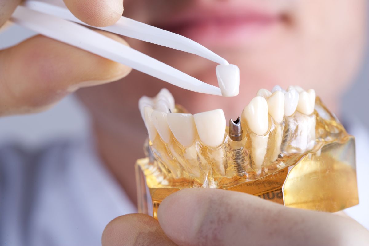 The Ultimate Guide to Dental Implants in Cape Coral: Procedure, Benefits, and Care