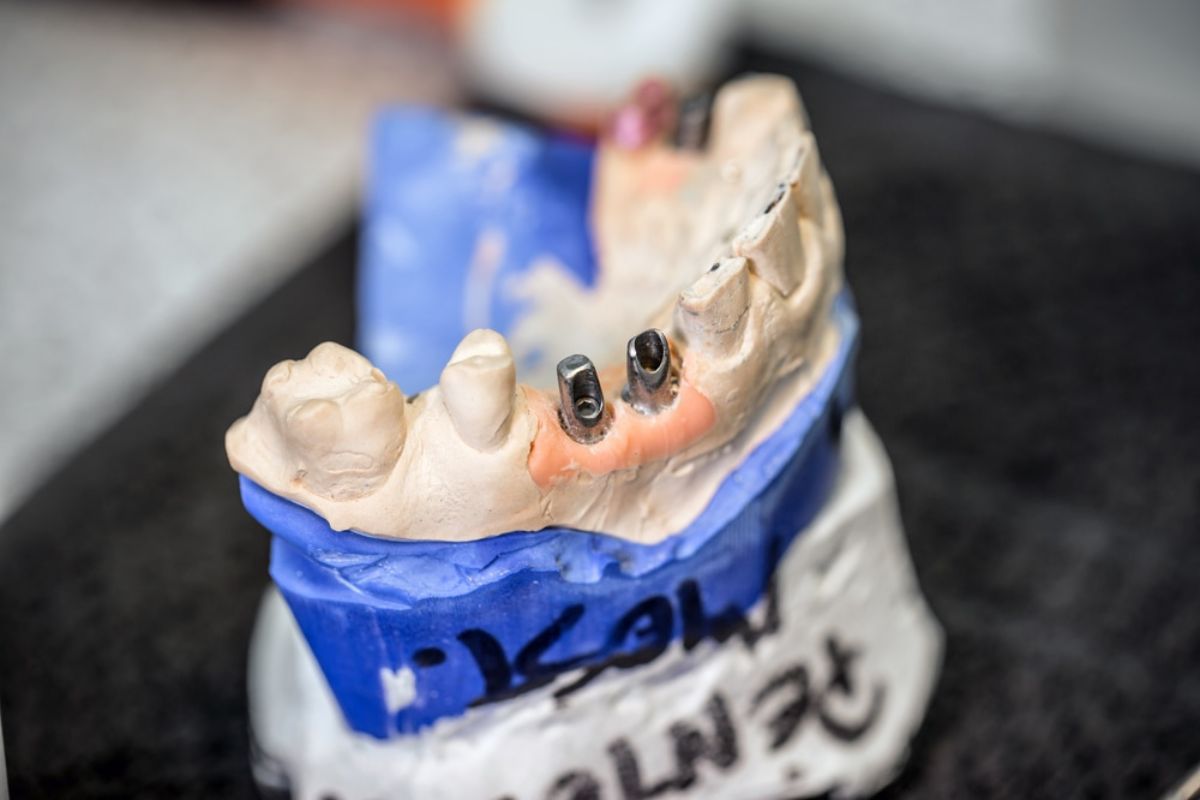 Why Dental Implants Are the Best Long-Term Solution for Tooth Loss