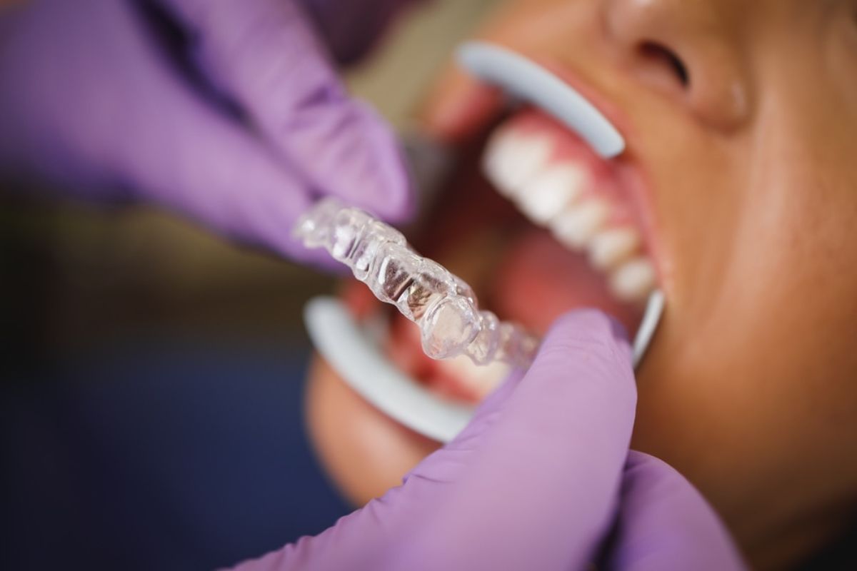 Can Invisalign Correct Overbites, Underbites, and Crooked Teeth? Here’s What You Need to Know