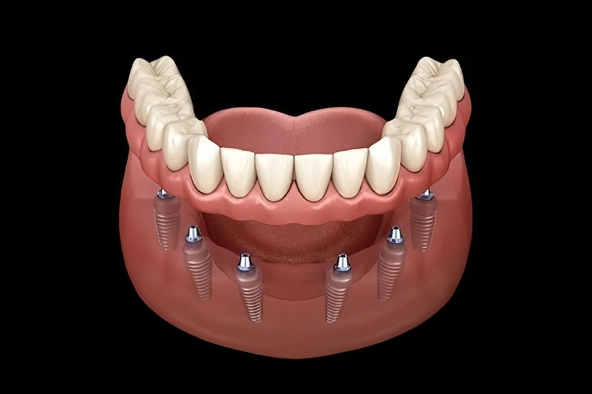 Why All-on-4 Implants Are The Best Solution For Missing Teeth?