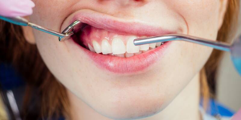 Is It Ever Too Late to Fix Receding Gums? What Cape Coral Patients Should Know