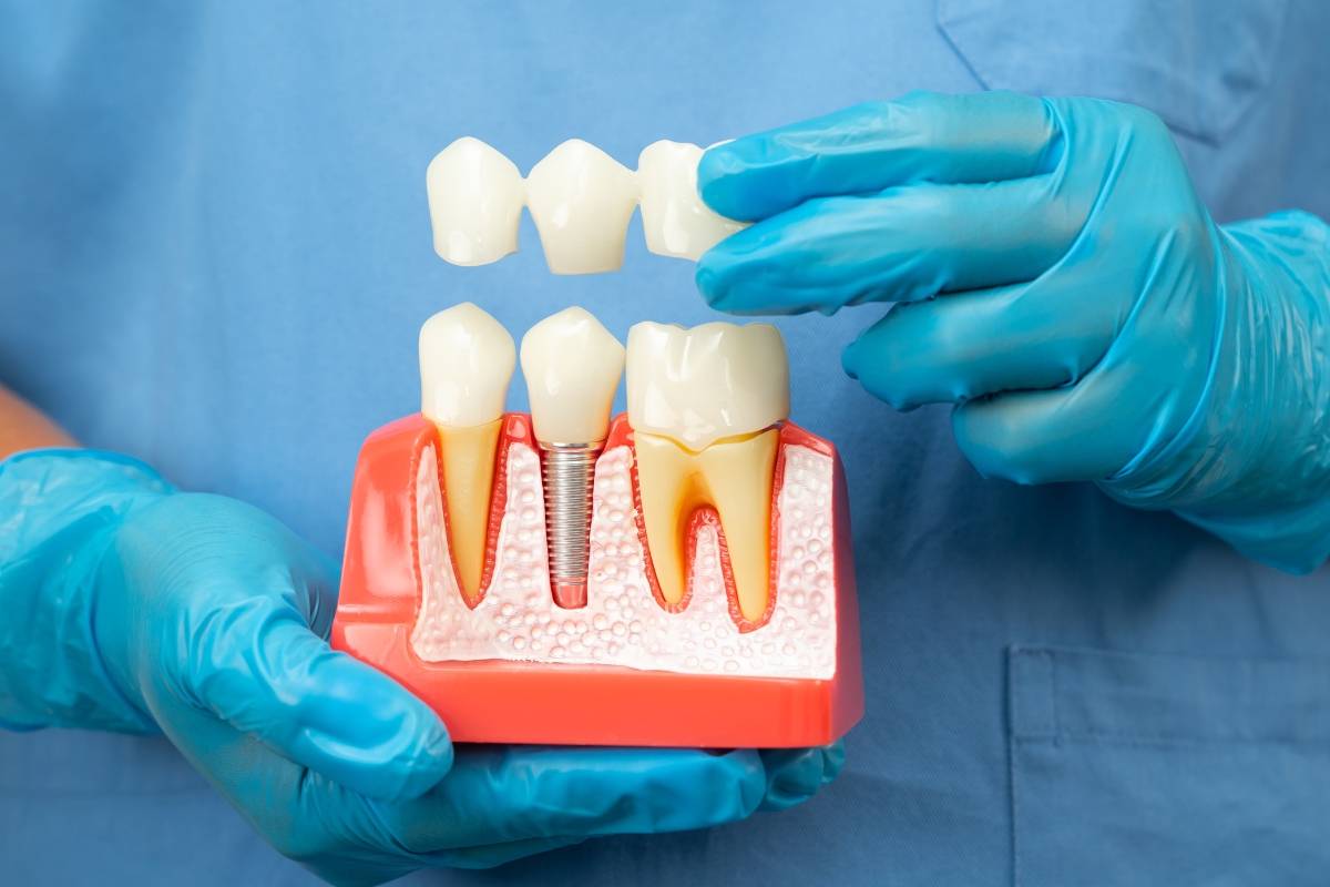 Do Dental Implants Hurt? What Cape Coral Patients Should Expect Before & After Surgery