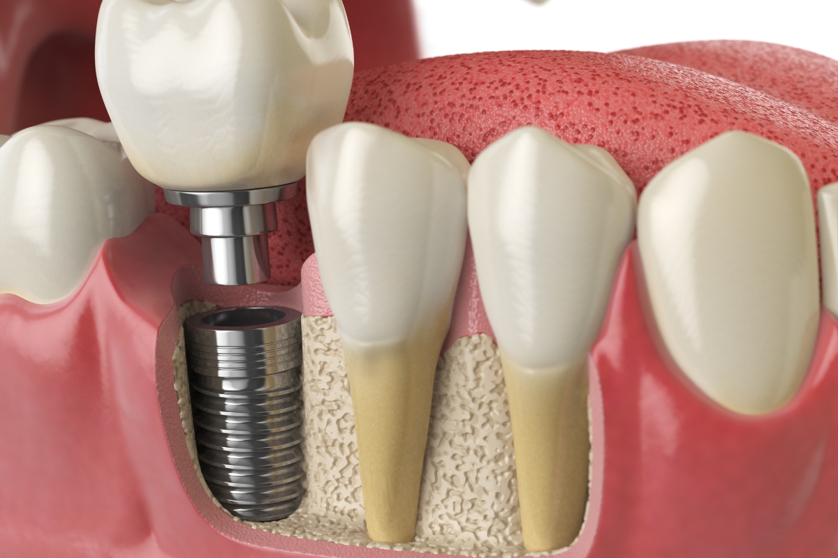 Our Dentist Explains the Common Causes of All-on-4 Dental Implant Failure