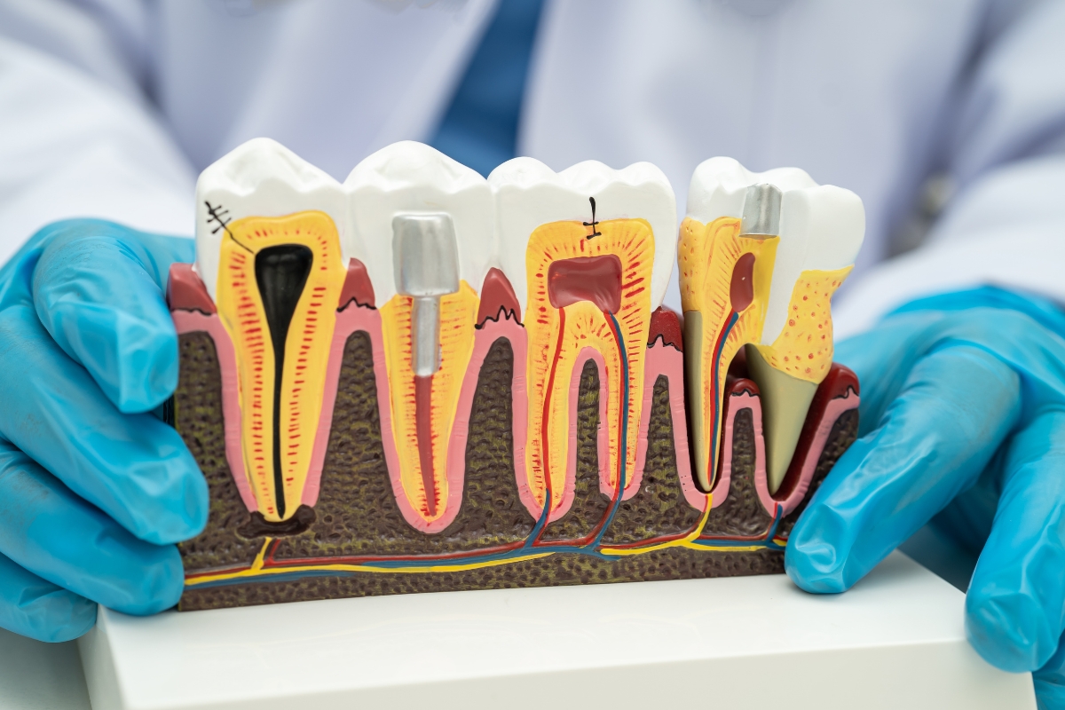 All-on-4 vs. Traditional Implants: Which is Best for Your Smile?